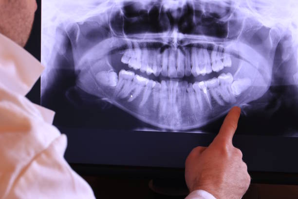 Best Emergency Tooth Extraction in Middletown, OH